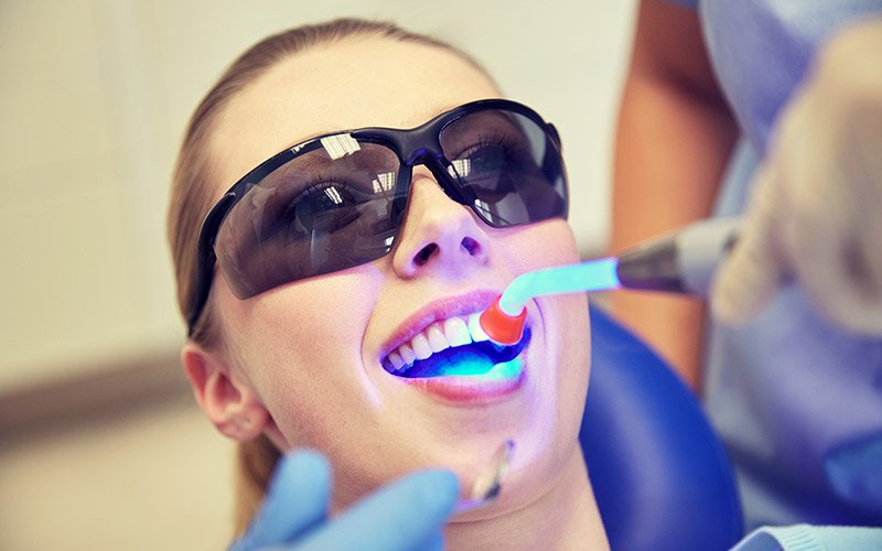 Dental Sealants